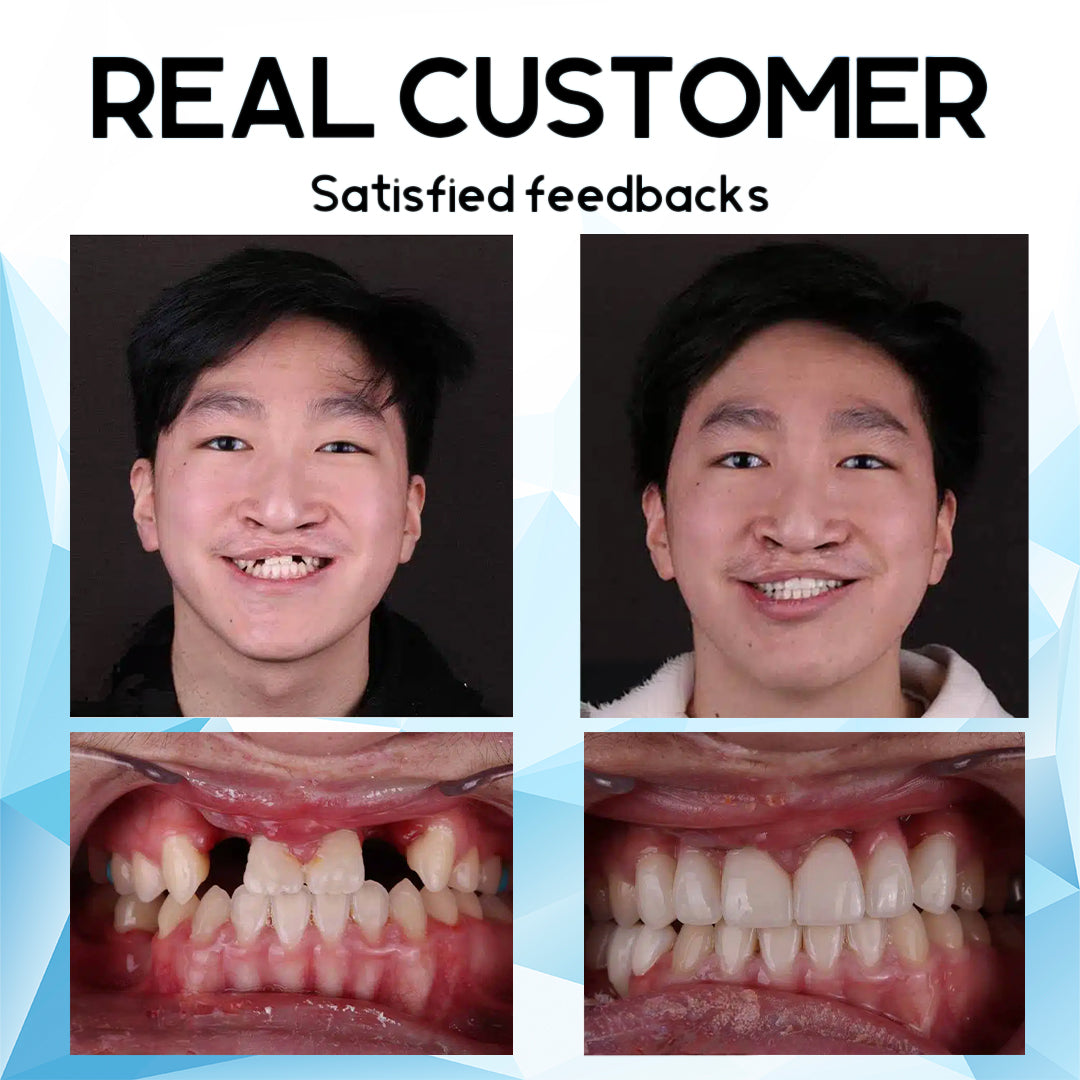 HERMSA™Silicone Reline Denture Set (👩🔬Dentist Recommendations👩🔬)