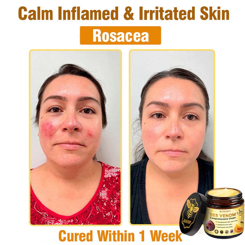 Raindew™ Bee Venom Comprehensive Cream (Suitable for all ages & TGA recommends)