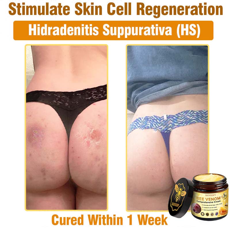 Raindew™ Bee Venom Comprehensive Cream (Suitable for all ages & TGA recommends)