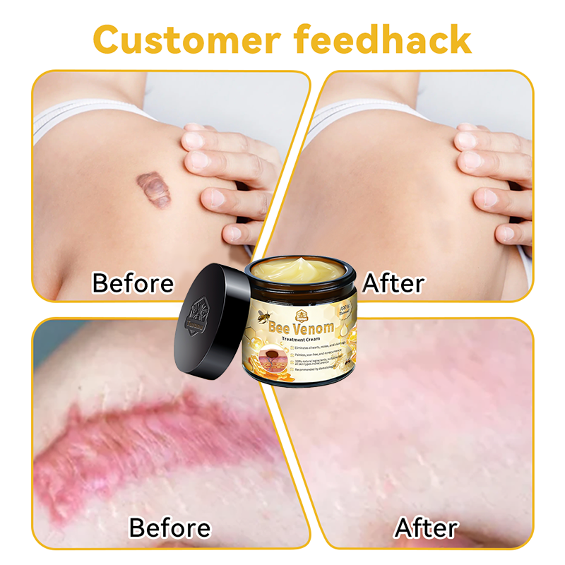AUS (TGA Recommended, FDA Approved) Turonu Bee Venom Treatment cream (last day promotion 80% off)