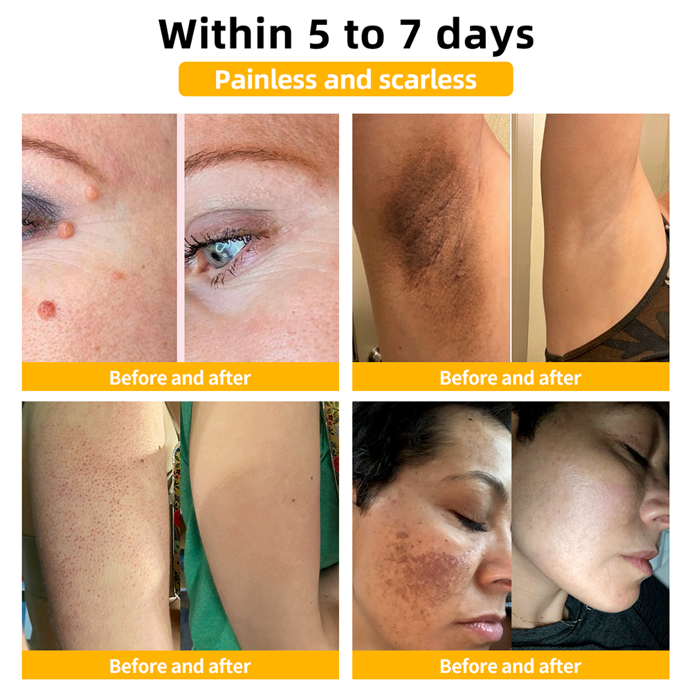 AUS (TGA Recommended, FDA Approved) Turonu Bee Venom Treatment cream (last day promotion 80% off)