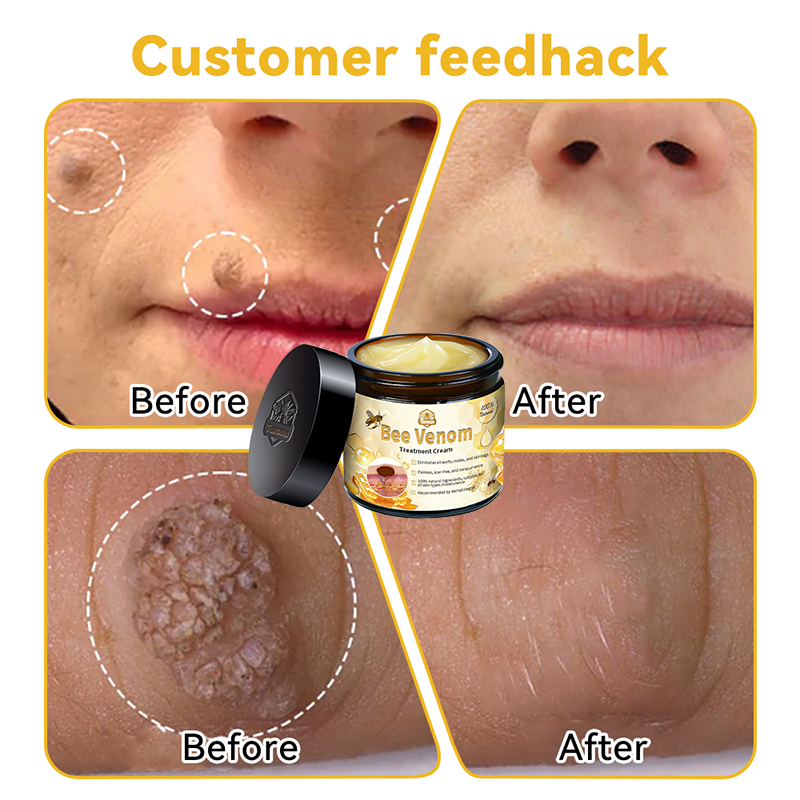 AUS (TGA Recommended, FDA Approved) Turonu Bee Venom Treatment cream (last day promotion 80% off)